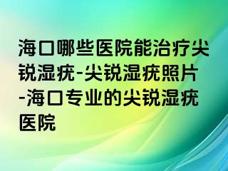 海口哪些医院能治疗尖锐湿疣-尖锐湿疣照片-海口专业的尖锐湿疣医院