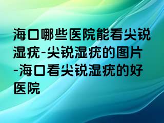 海口哪些医院能看尖锐湿疣-尖锐湿疣的图片-海口看尖锐湿疣的好医院