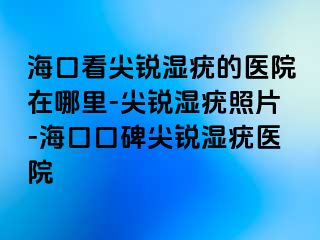 海口看尖锐湿疣的医院在哪里-尖锐湿疣照片-海口口碑尖锐湿疣医院